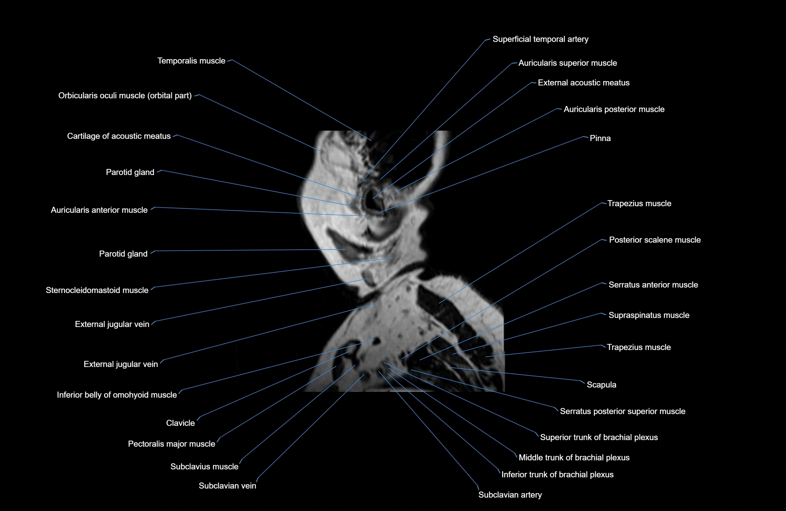 Neck MRI sagittal cross sectional anatomy 3D 1mm 3T radiology  image-img-00001-00040.webp